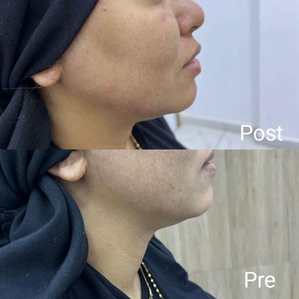 فيلر تحديد الفك